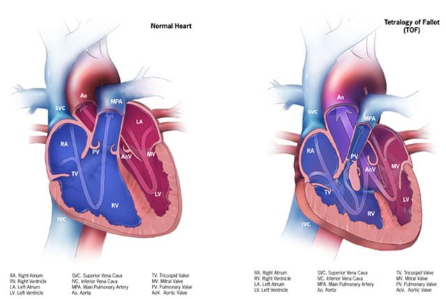 Tetralogy of fallot 1